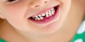 Süt Dişleri Neden Önemli?