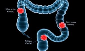 Takipte Kalın! Kolon Kanserini Önlemek İçin Yapabileceğiniz En İyi Şey.