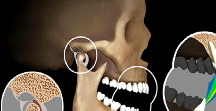 TEMPOROMANDİBULAR EKLEM DİSFONKSİYONU
