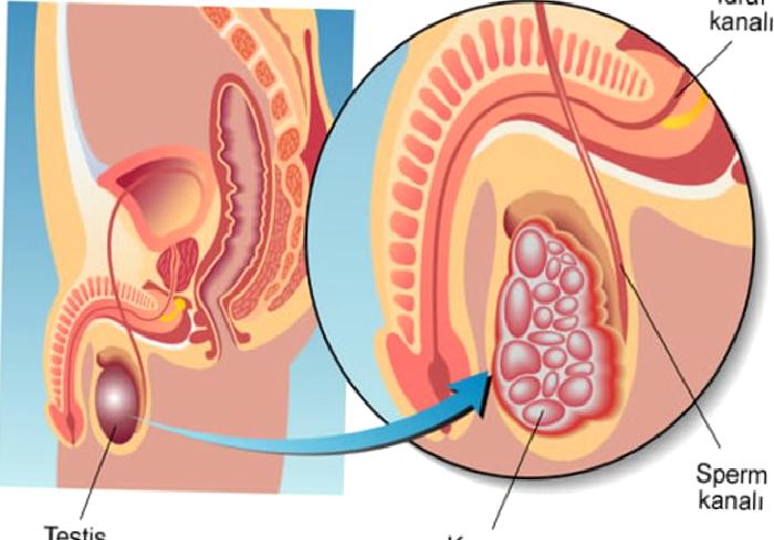Testis Kanseri