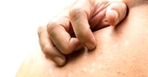 Tinea Versicolor Nedir?