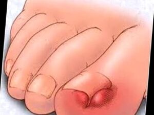 Tırnağım Neden Batıyor?