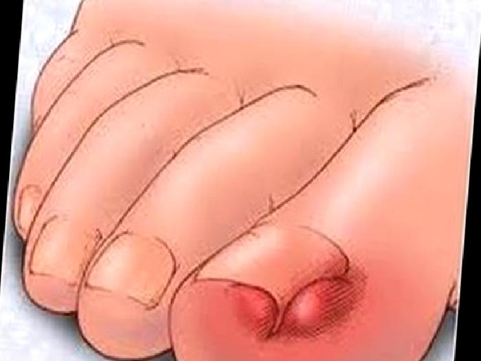 Tırnağım Neden Batıyor?