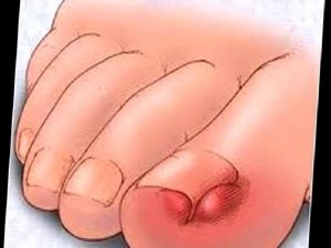 Tırnak Batığı Nedir?