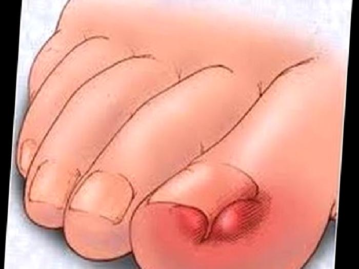 Tırnak Batığı Nedir?