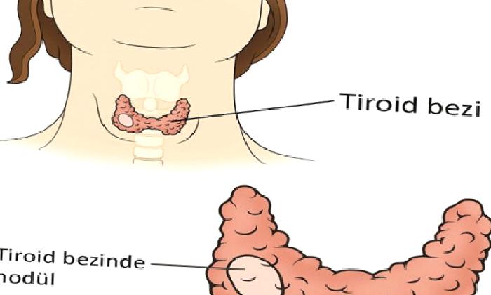 Tiroid