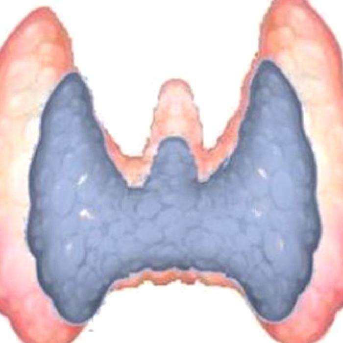 Tiroid Yetmezliği (Hipotiroidizm)