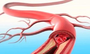 Toplardamar (ven) Tıkanıklığı