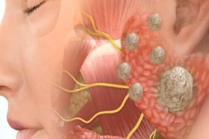 Tükürük Bezi Hastalıkları