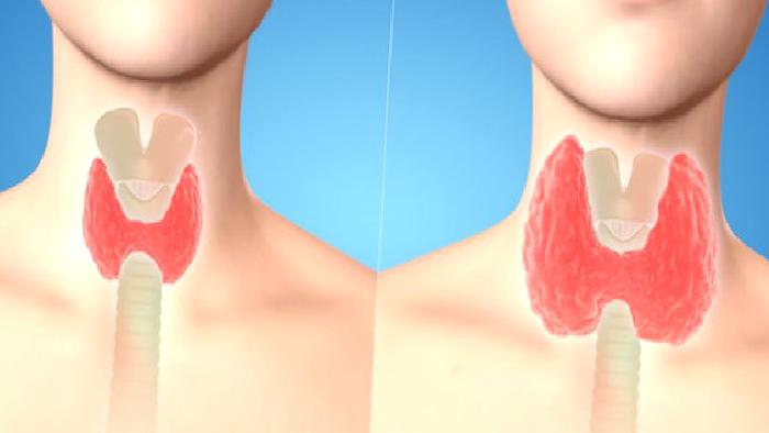 Tükürük Bezi Tümörleri