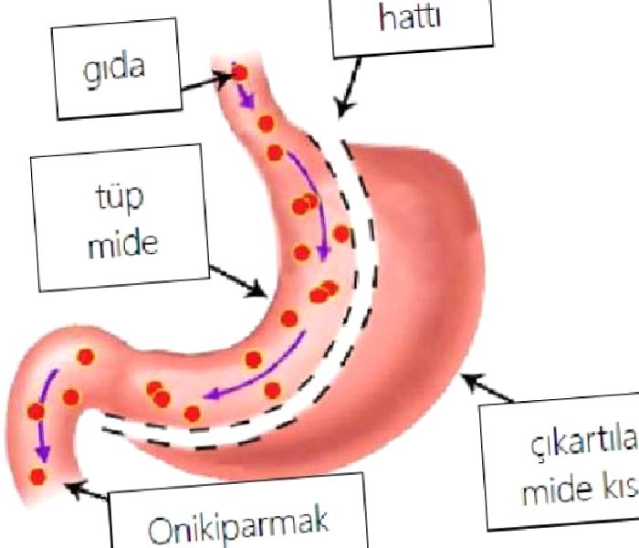 Tüp Mide Ameliyatı