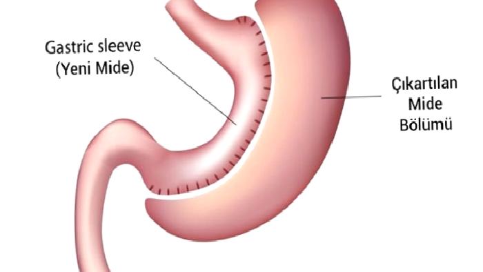 Tüp Mide Ameliyatı