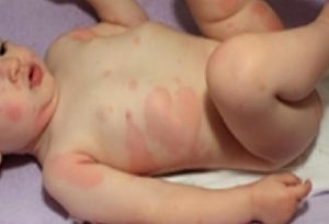 ÜRTİKER | ALERJİK ANJİYOÖDEM