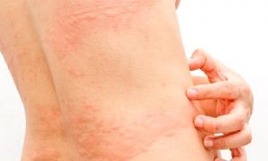 Ürtiker (kurdeşen)