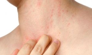 Ürtiker (Kurdeşen)