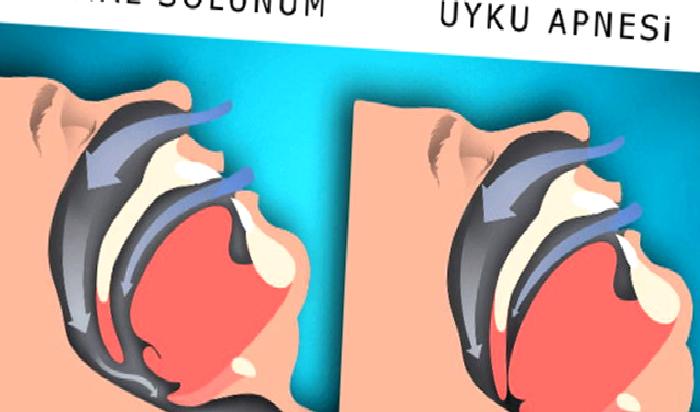 UYKU APNESİ