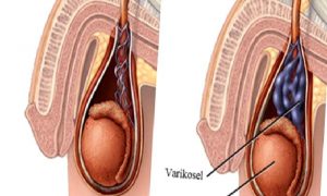 VARİKOSEL NEDİR?