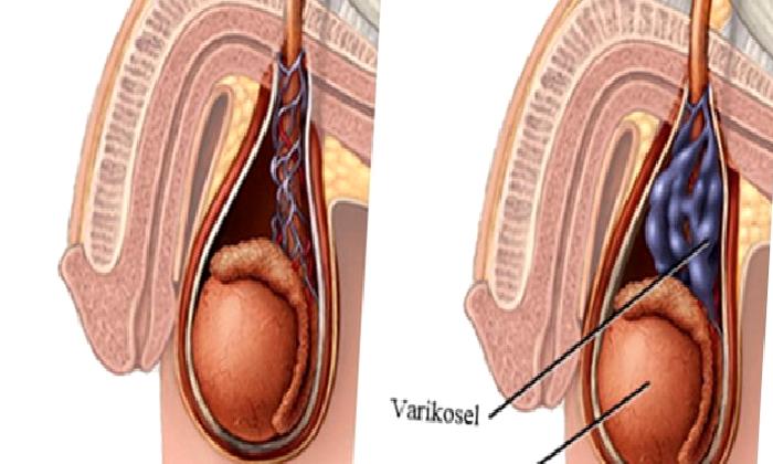 VARİKOSEL NEDİR?
