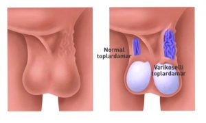 VARIKOSEL NEDİR?