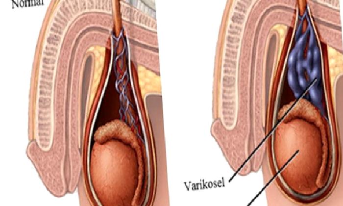 VARİKOSEL NEDİR  TEDAVİSİ NASIL YAPILIR?