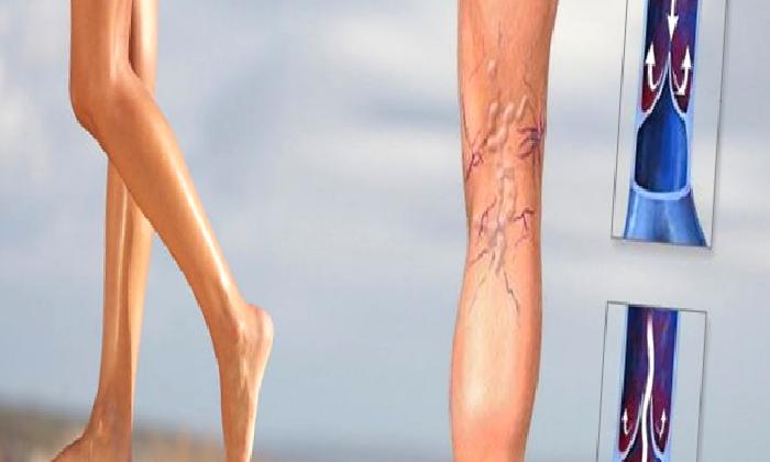 Varis Tanısı Nasıl Konur?