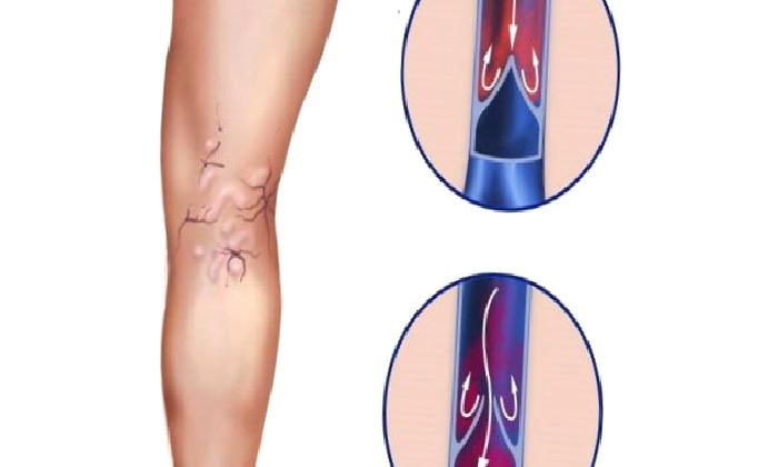 Varisler Kaç Tip Varis Vardır?