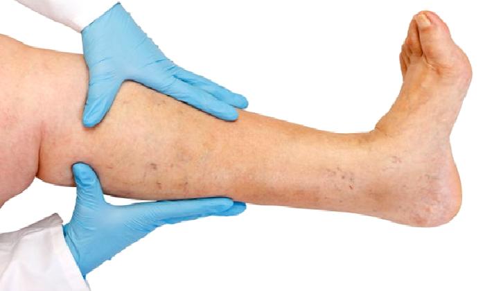 Varisler Varis Hastalığının Bulguları Nelerdir?