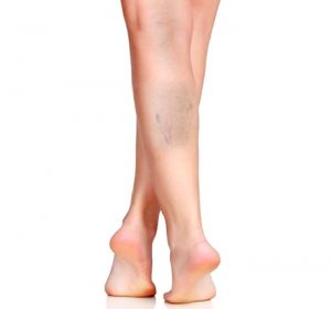 Variste Skleroterapi ve Yapıştırma Yöntemi