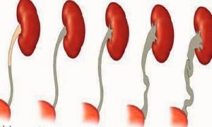 VEZİKOÜRETERAL REFLÜ/VUR (BÖBREK KAÇAĞI)