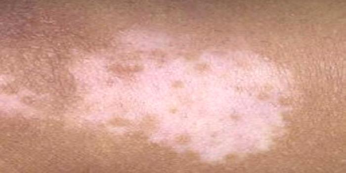 Vitiligo