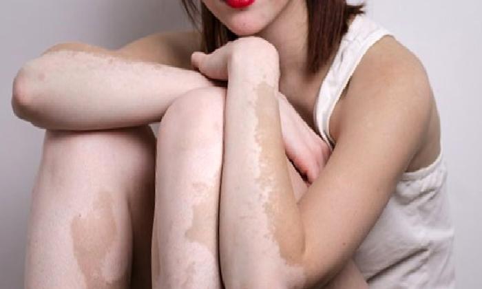 Vitiligo (Ala hastalığı)