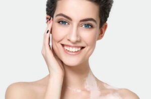 Vitiligo Nedir?