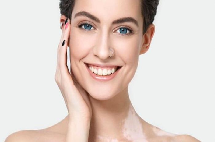 Vitiligo