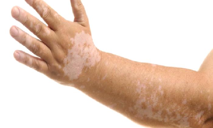 Vücudumuzdaki Beyaz Lekeler