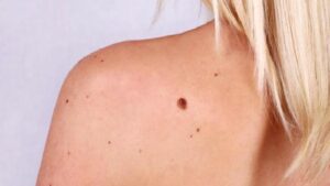 Vücudumuzdaki Lezyonlarla (Benler) İlgili Doğru Bilinen Yanlışlar