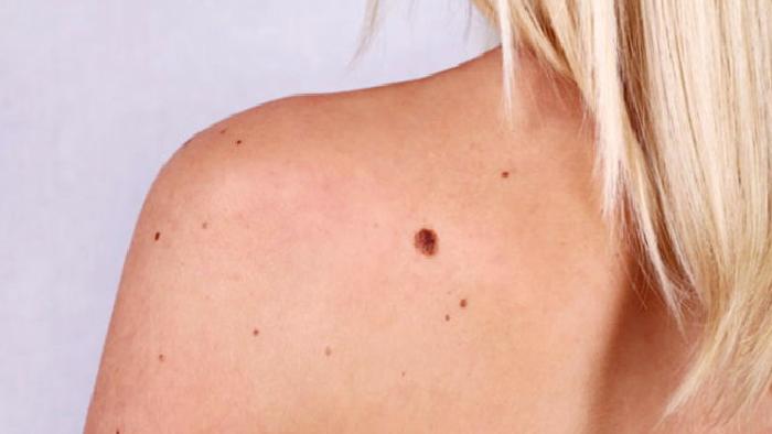 Vücudumuzdaki Lezyonlarla (Benler) İlgili Doğru Bilinen Yanlışlar