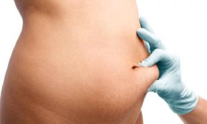 Yağ alma (liposakşın – lipoplasti)