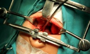 Yarık Damak Yarık Dudak