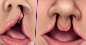 Yarık Dudak ve Damak