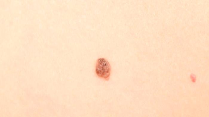 Yaz Ayları Dikkatimizi Çeken Benler