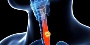 Yemek Borusu Hakkında Merak Edilenler