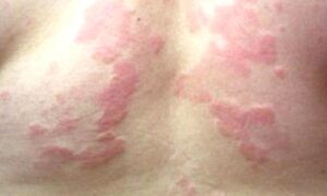 YETİŞKİNLERDE ÜRTİKER ( Kurdeşen ) NEDİR?