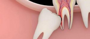 Yirmi Yaş Dişi Ameliyatı