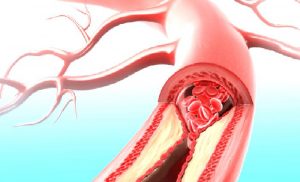 Yorgunluğun nedeni fibromiyalji olabilir