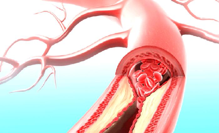 Yorgunluğun nedeni fibromiyalji olabilir