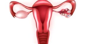 Yumurtalık Kistleri