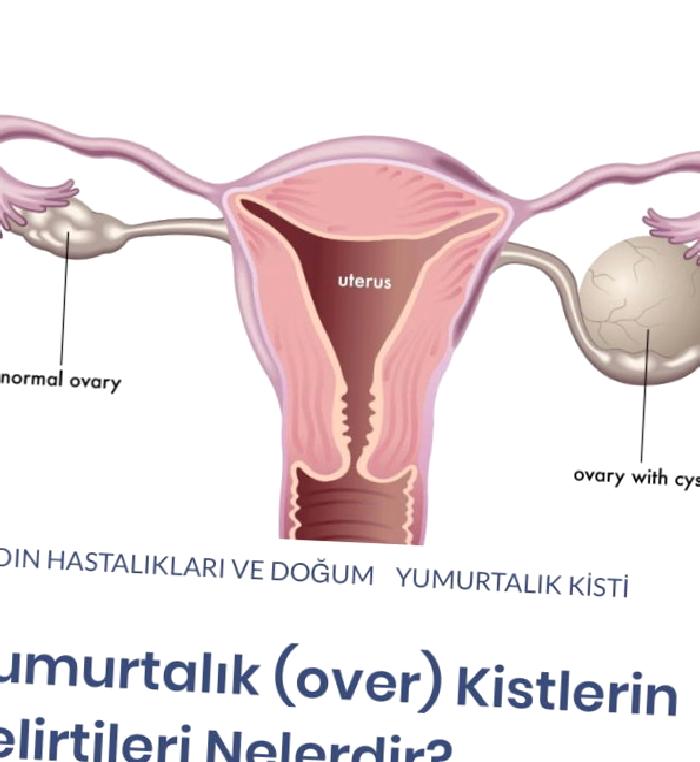 Yumurtalık (over) Kistlerin Belirtileri Nelerdir?