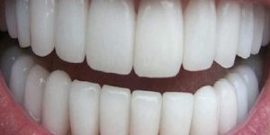 Zirconium Restorations