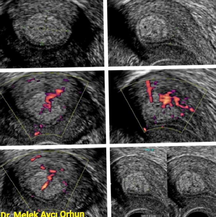 Endometrial Polip Nedir,  Tanı Olarak Kullanılabilecek İnceleme Yöntemleri Nelerdir?