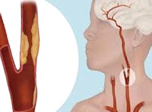 Şah Damarı Tıkanıklığı